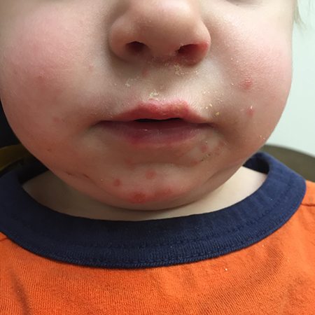 Hand-Foot-Mouth Disease 1 copy