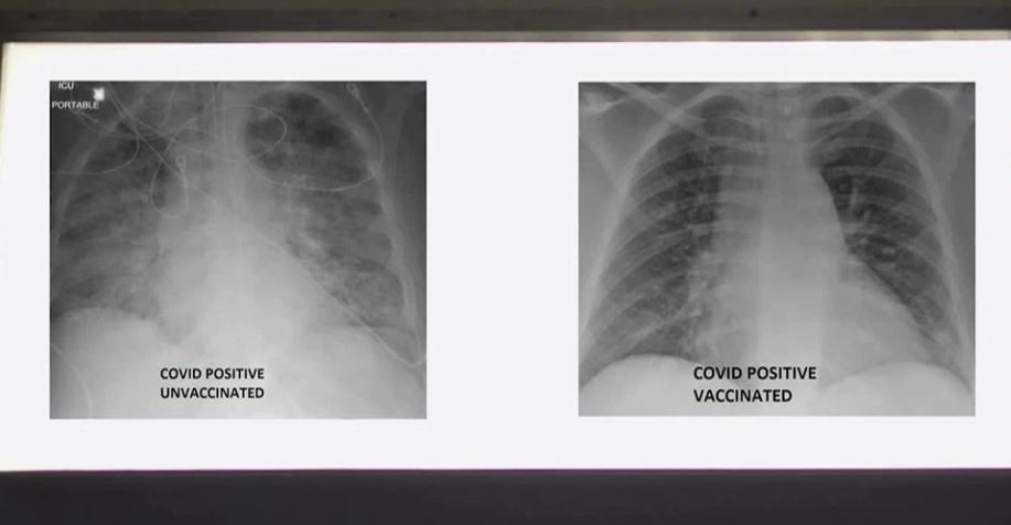 震驚！感染 COVID-19 的肺部在 X 光顯示下接種疫苗和未接種疫苗差異巨大