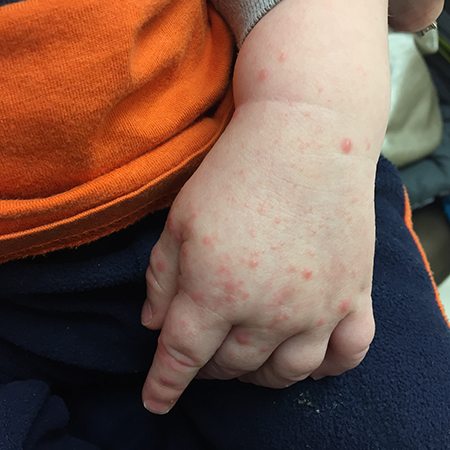 哇靠!亲子主题特刊 儿童夏季常见的皮肤问题