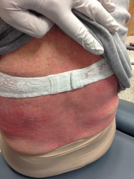 [刘医师专栏] 浅谈药物过敏 - wacowla 哇靠!洛杉矶 los angeles : wa